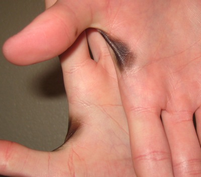 hands with dark spots